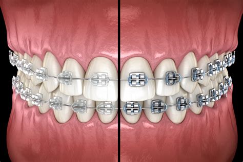 metal vs ceramic brackets|traditional metal braces vs ceramic.